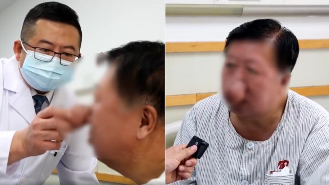 40年豪飲4千公斤白酒 陸男「長出象鼻」喝湯燙到