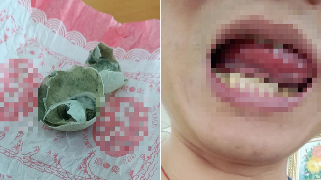 爽嗑皮蛋灼傷口腔! 他痛曝「口內慘況」:前所未見