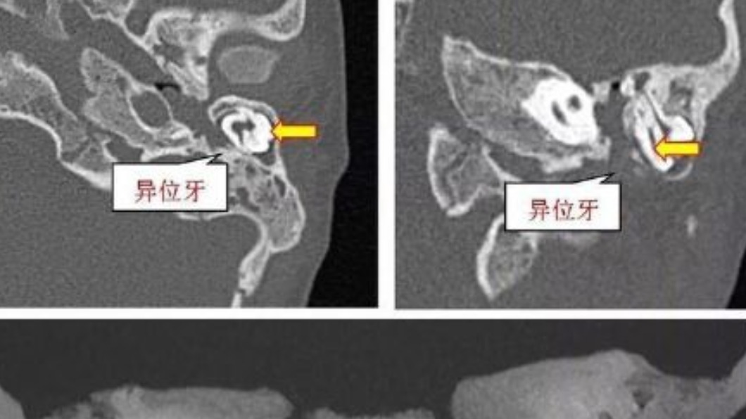 男童耳朵裡有3顆完整牙齒。（圖／翻攝自微博）