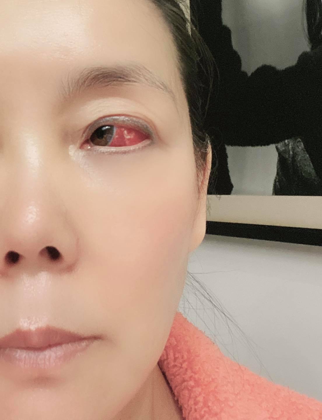 辛曉琪昨在臉書上貼出左眼血管爆掉的驚悚照。(圖/翻攝自辛曉琪臉書)
