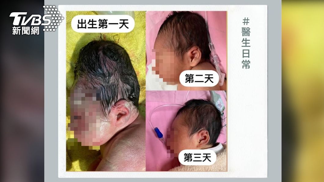 「寶寶頭超長」嚇壞嬤 醫樂揭原因:趕快拍照!