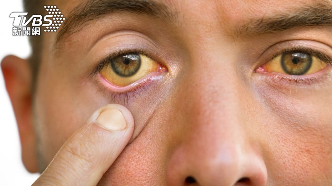 肝病造成的黃疸會造成眼白變黃。（示意圖／shutterstock達志影像）