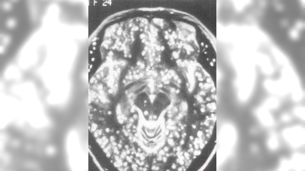 頭痛劇烈!陸男「腦袋長滿寄生蟲」 醫曝愛生食嚴重後果