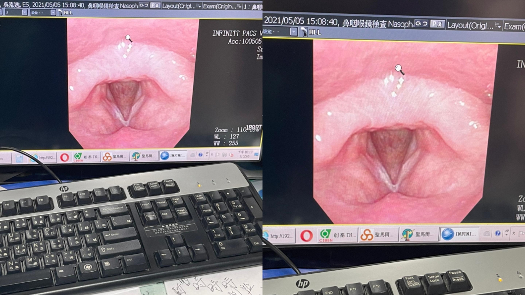 鳳梨聲帶長白斑。(圖/翻攝自鳳梨 吳泓逸Facebook)