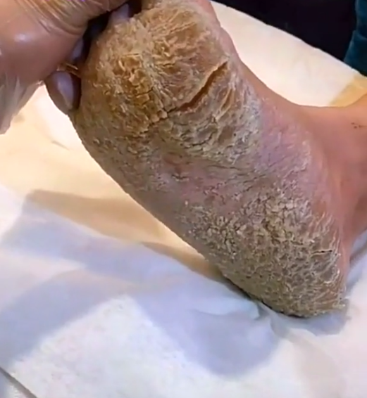顧客腳底出現龜裂情形。（圖／翻攝自minke328 TikTok）