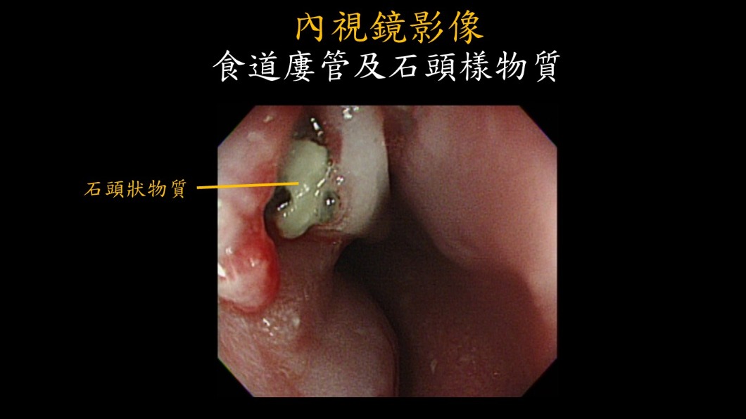 內視鏡影像。(圖/義大醫院提供)