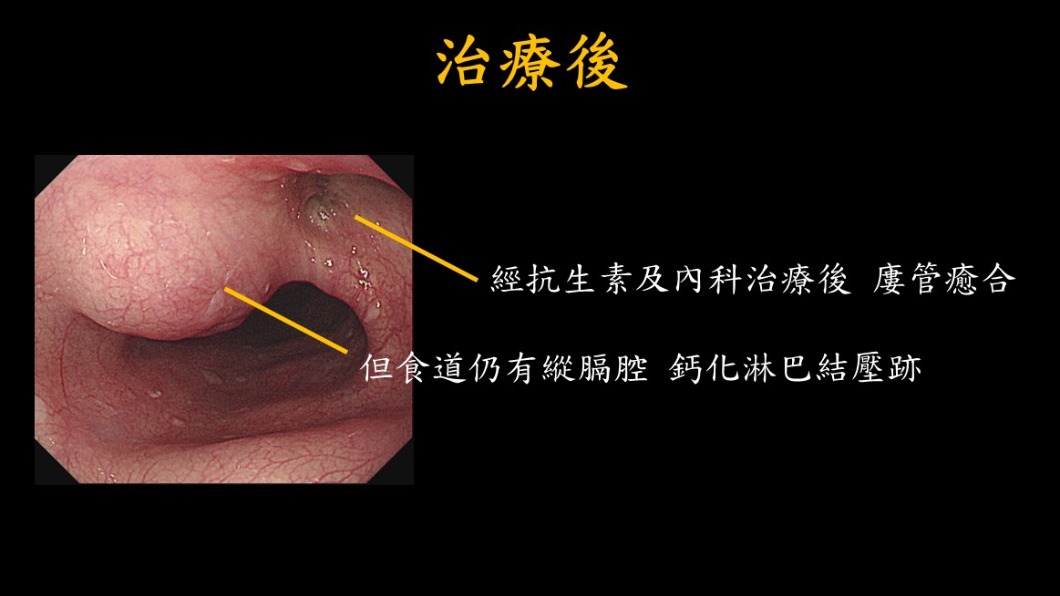治療後的情況。(圖/義大醫院提供)