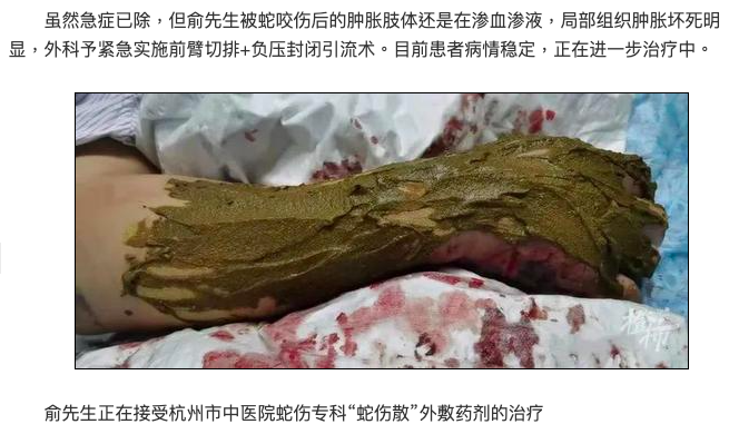 男子被蛇咬中毒後入院治療。(圖/翻攝自都市快報)