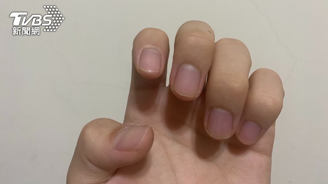 擔心無症狀快樂缺氧?醫曝指甲「出現這色」快送醫
