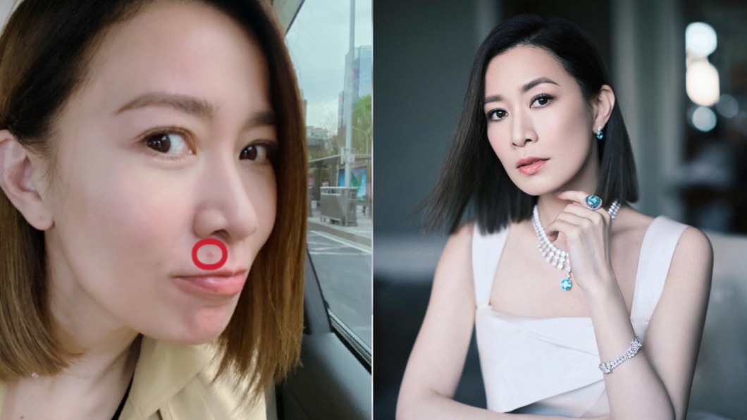 惱人痘痘反覆長不停!女星曝5大愛用抗痘法寶
