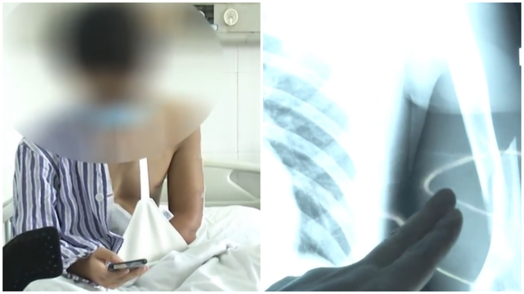 男大生就醫後診斷是粉碎性骨折。（合成圖／翻攝自微博）