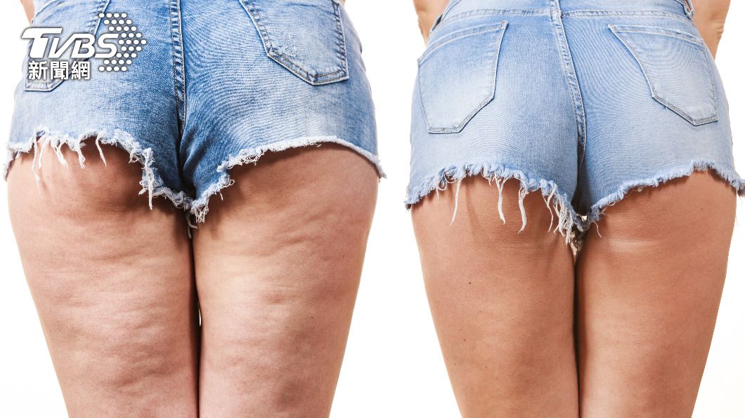 85%女性都有橘皮問題 靠按摩、飲食4招找回光滑肌