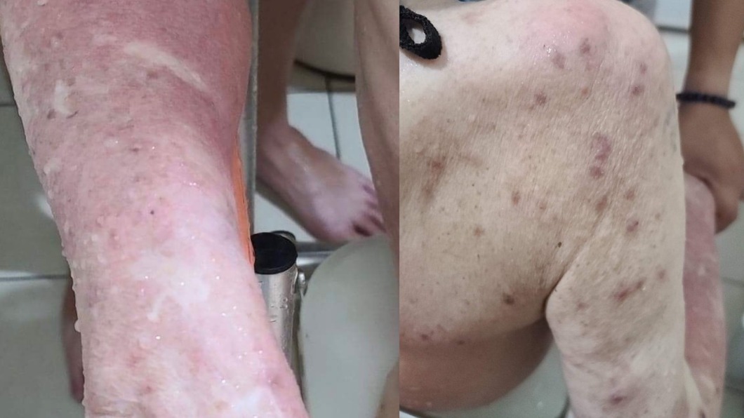 探親見父滿身疥瘡　家屬質問安養院反遭嗆：哪間沒有蟲