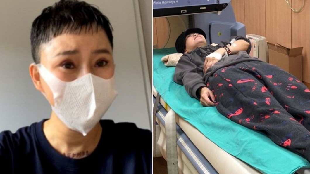 詹雅雯頭髮狂掉「最嚴重恐開腦」!經紀人曝最新病況