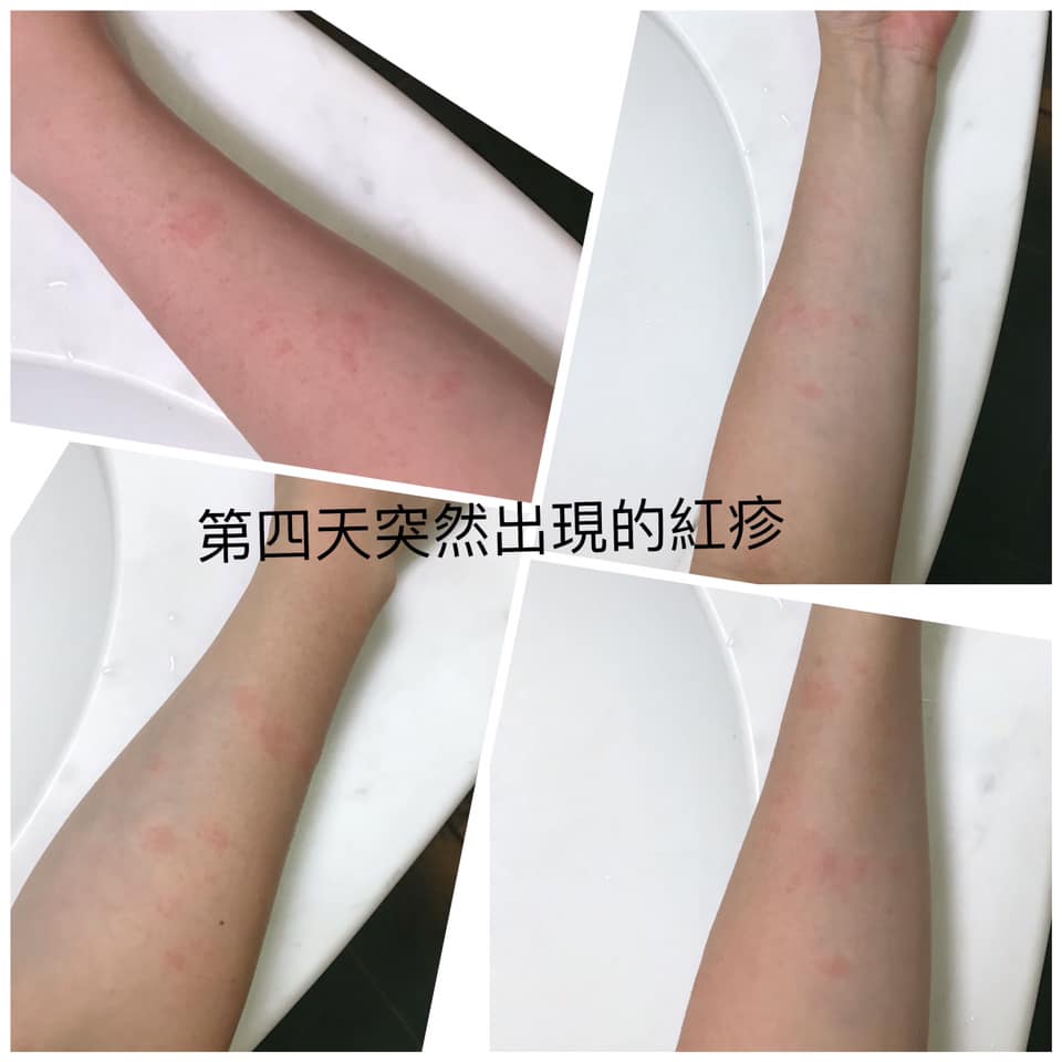 原po第四日圖出現紅疹,口服抗過敏藥物後就消失了。(圖/翻攝自爆料公社公開版臉書)
