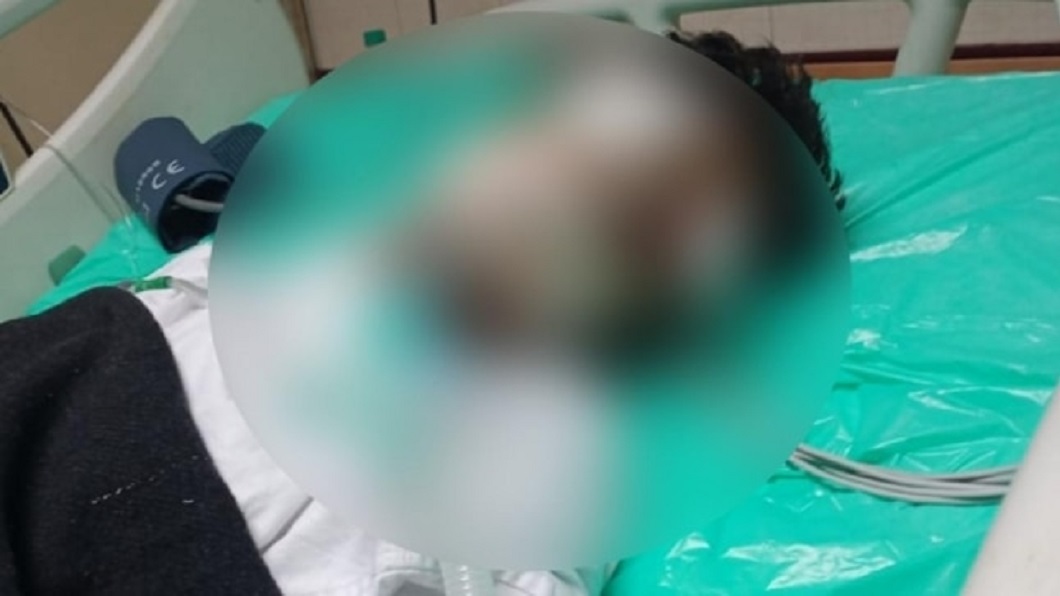 恐怖！印度重症男住加護病房　左眼「被老鼠咬」狂冒血
