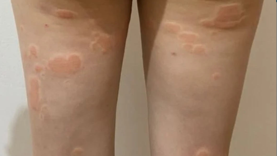 好癢!民眾搶打莫德納疫苗 這女子接種後全身出現「這東西」