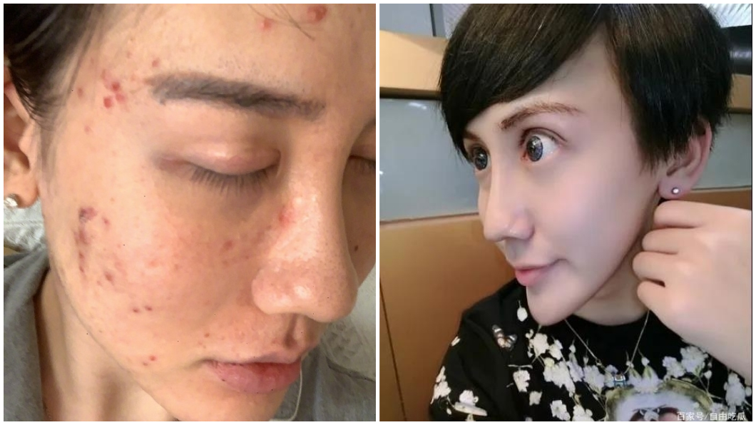 蛇精男透露先前曾染上新冠肺炎但現在已經康復。（合成圖／翻攝自微博）