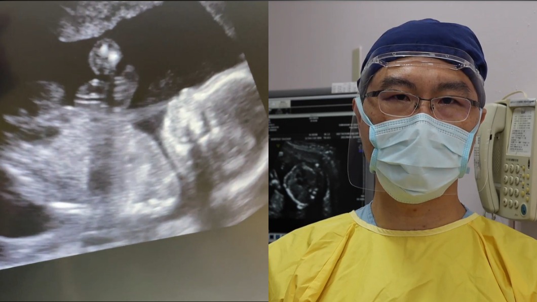 孕婦施打莫德納安全嗎? 婦科醫師親自解答