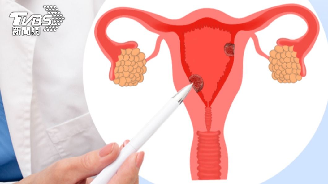 子宮內膜癌有年輕化的趨勢。(示意圖/shutterstock達志影像)