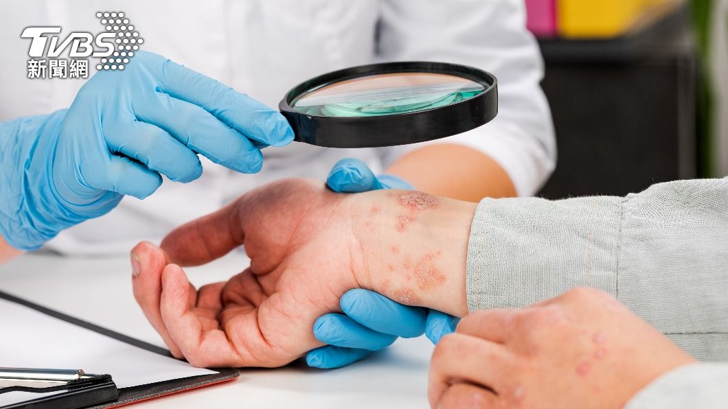 研究指出,生物製劑治療乾癬症狀效果較佳。(示意圖/shutterstock達志影像)