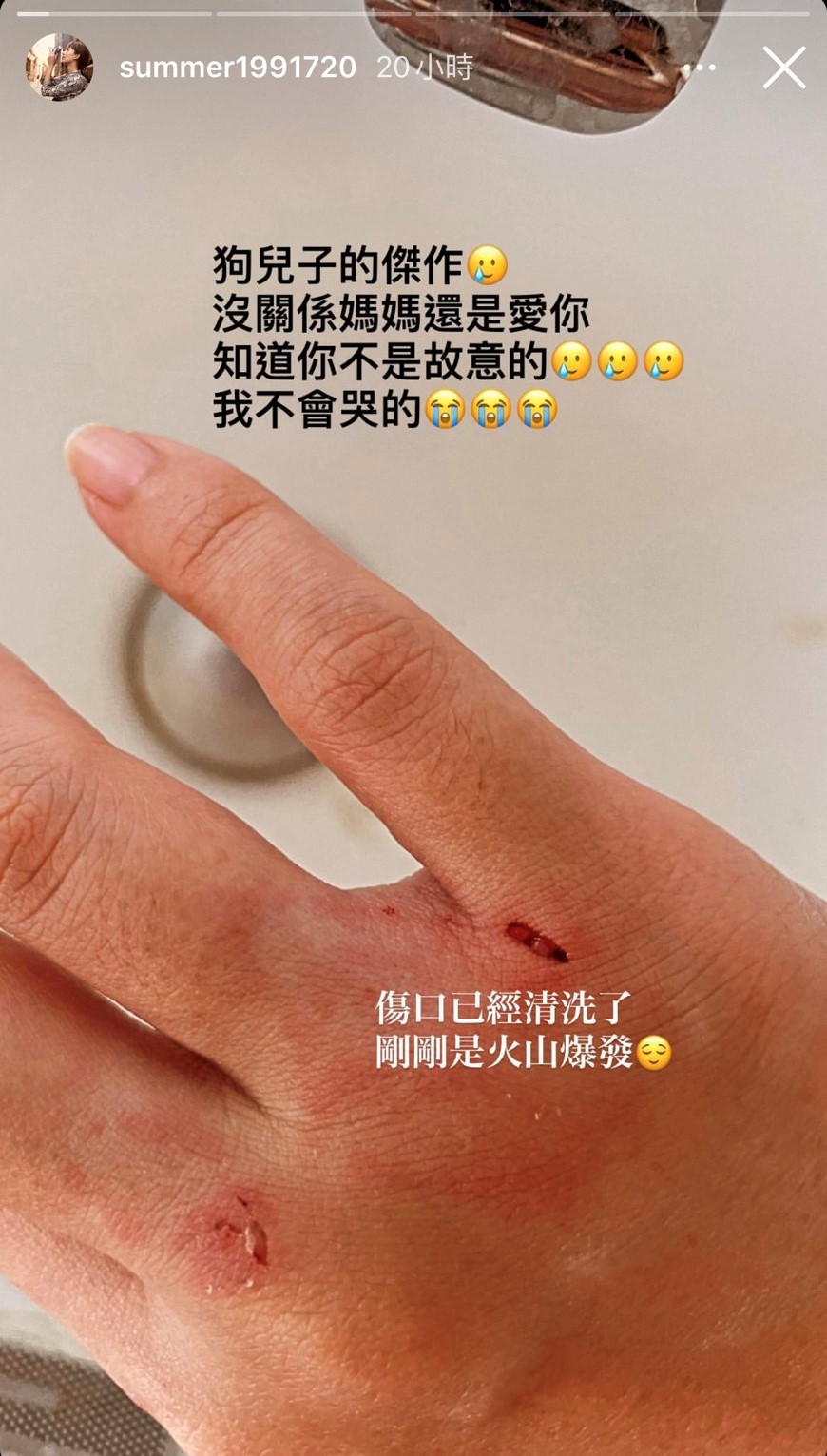 孟耿如被愛犬咬傷。(圖/翻攝自孟耿如臉書)