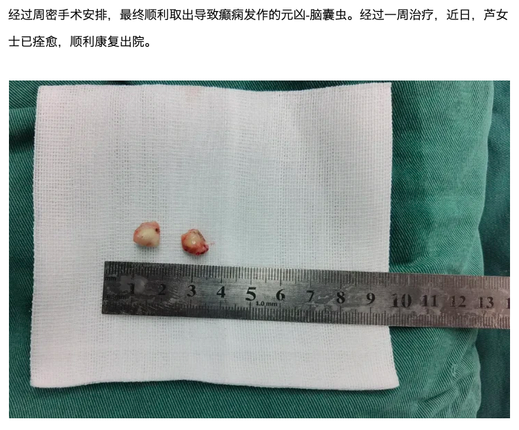 手術取出腦內囊蟲。(圖/翻攝自福建衛生報)