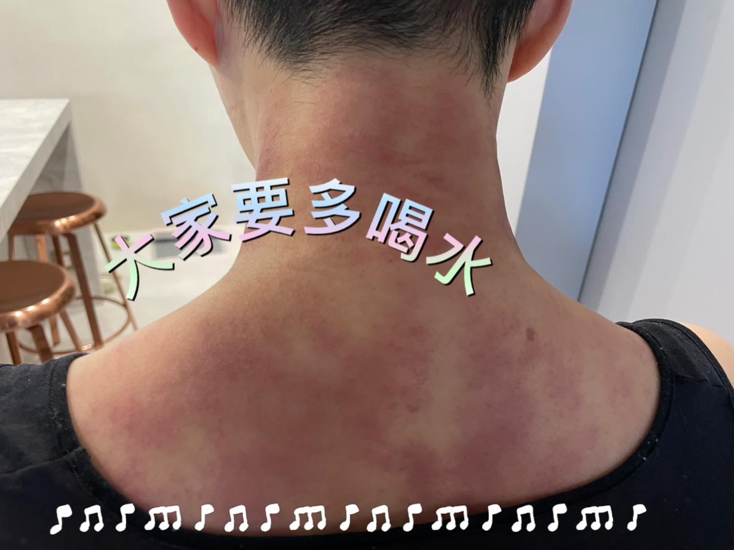 詹雅雯貼出刮痧照。(圖/翻攝自詹雅雯臉書)