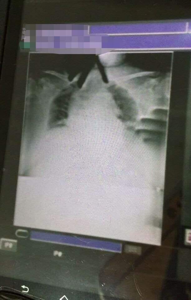 阿嬤醒來後也敘述的經歷與X光片不謀而合。(圖/網友授權提供報導)
