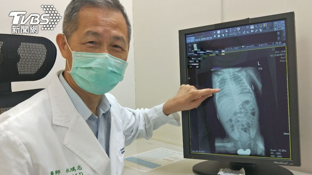 先天基因異常靠呼吸器維生 台中3歲罕病女童等換肺
