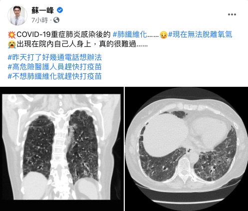 醫師蘇一峰在臉書貼出確診重症病患「肺纖維化」的照片。(圖/翻攝自蘇一峰臉書)