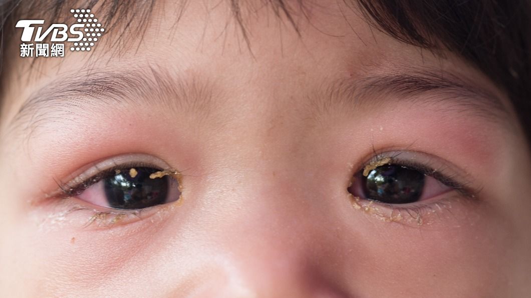 孩子眼睛浮腫別輕忽!4症狀中2項恐「這疾病」找上門