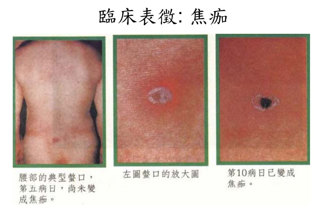 若被叮咬處會出現典型症狀「無痛性焦痂」。(圖/翻攝自衛福部官網)