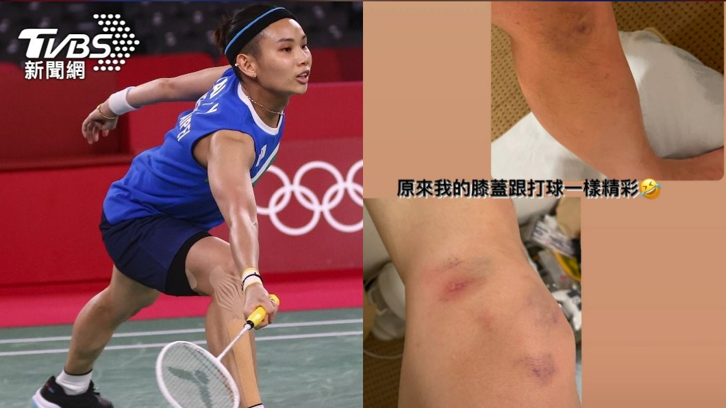 「膝蓋跟打球一樣精采」 小戴PO雙腿照：我沒事