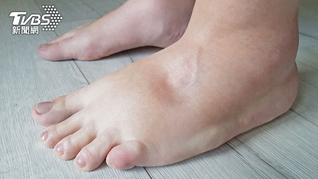 留鉀排鈉!泡泡眼別再來了 超強6大類「消水腫」食物