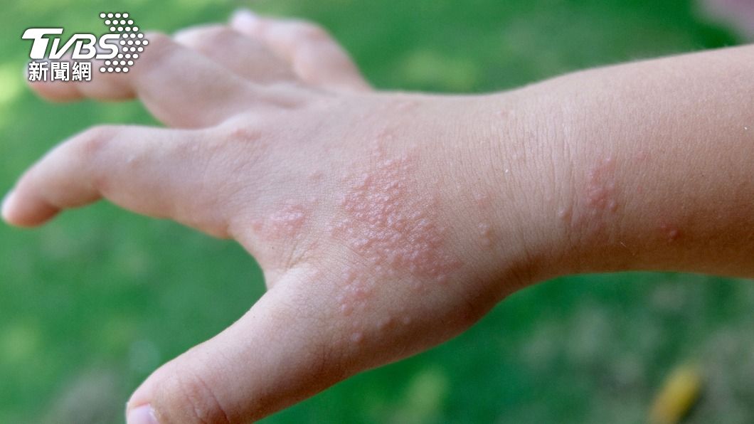 癢到凍未條!手腳狂冒「西米露」 醫籲別抓曝嚴重後果