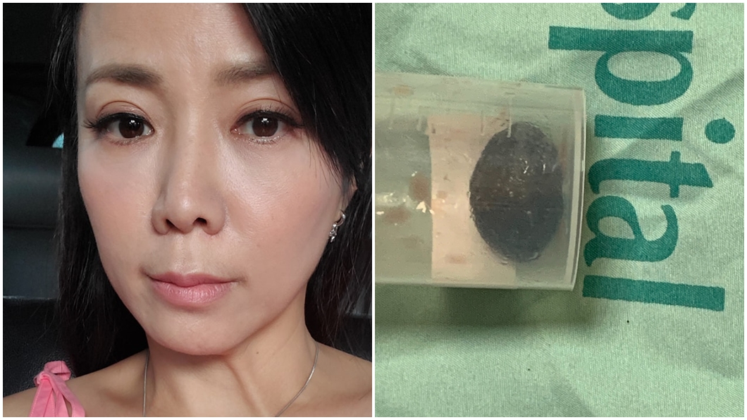 陳仙梅老公急性膽囊開刀，取出膽囊。（圖／翻攝自陳仙梅臉書）