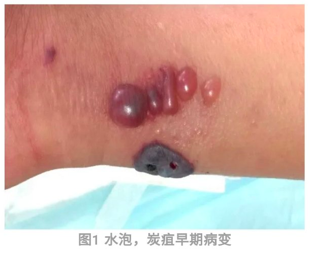 感染後病人皮膚會先出現水泡。(圖/翻攝自北京市疾病預防控制中心微博)