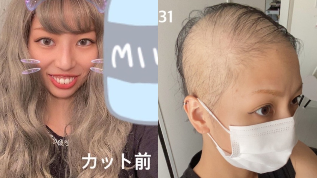 日女打莫德納變禿頭!勇打第2劑現況曝 BNT也傳掉髮
