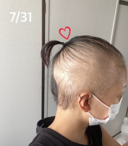 女子即使因不明原因嚴重落髮,仍接種完2劑莫德納疫苗。(圖/翻攝自Ameba)