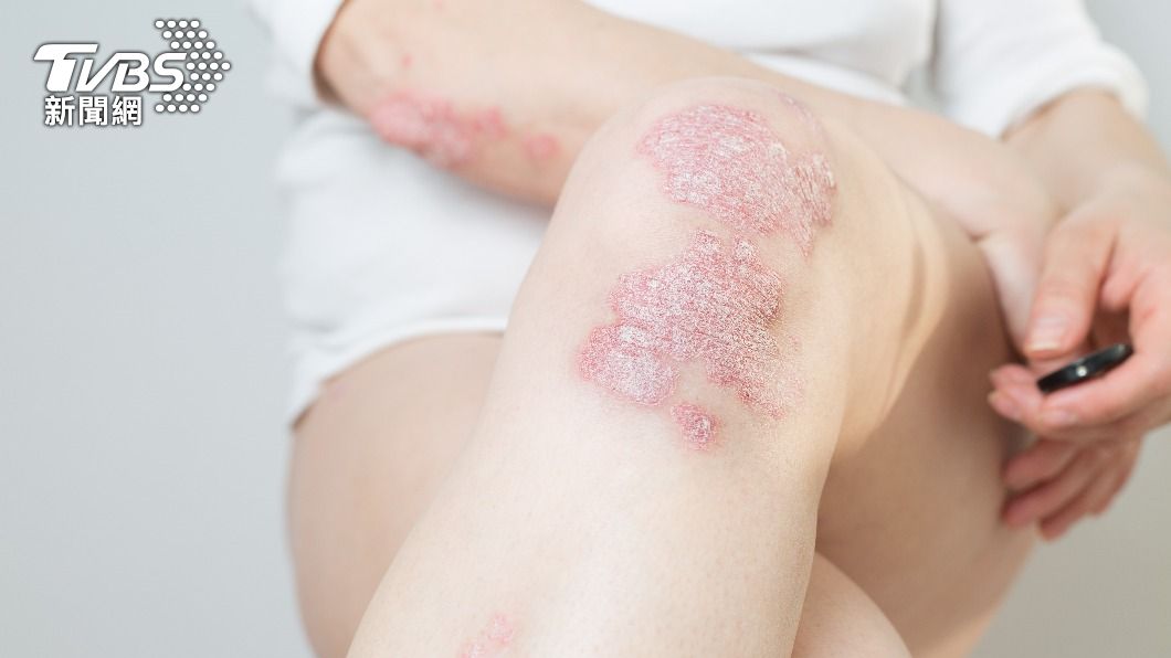 乾癬雖然無法根治,不過仍可以藥物、生物製劑來控制。(示意圖/shutterstock達志影像)