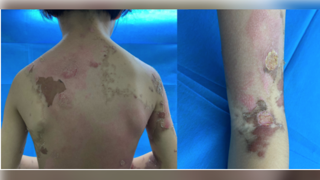女孩經治療後,病情已逐漸好轉。(圖/翻攝自湖南省兒童醫院 官網)