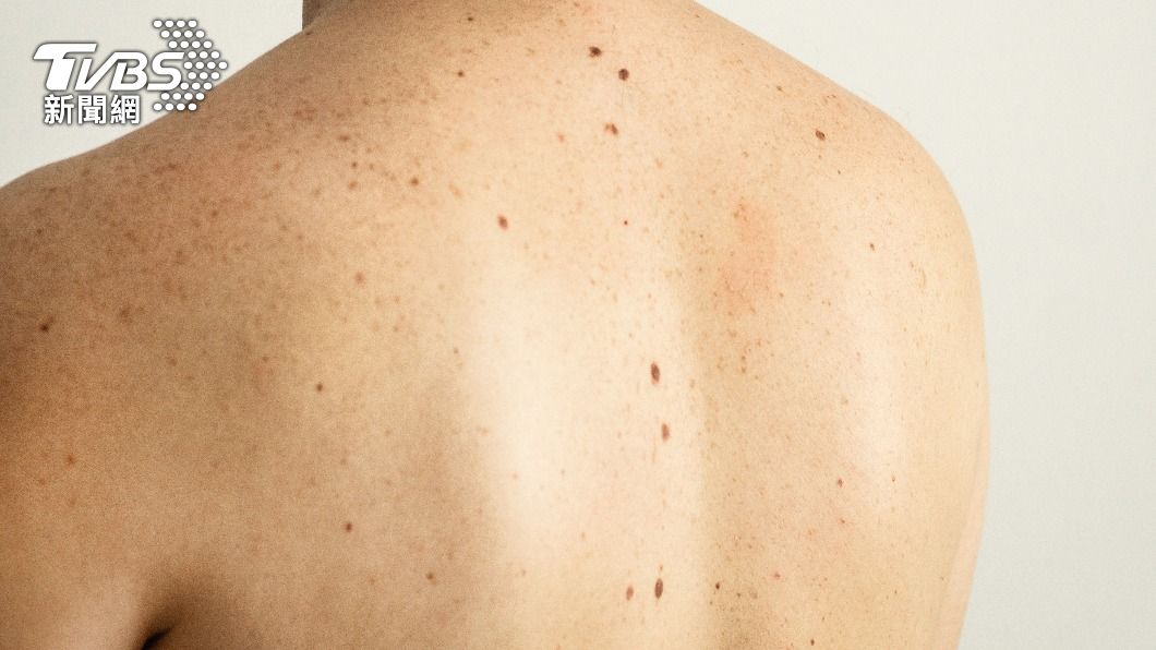 皮膚出現不起眼小痣?5大徵兆恐是「罹癌跡象」