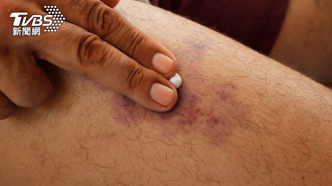打疫苗不能揉否則易血栓？醫揭真相：1招減緩注射點疼痛