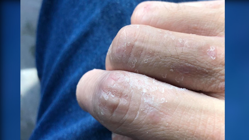 手莫名脫皮被問生肖 皮膚科醫下句秒惹怒他:你才屬蛇