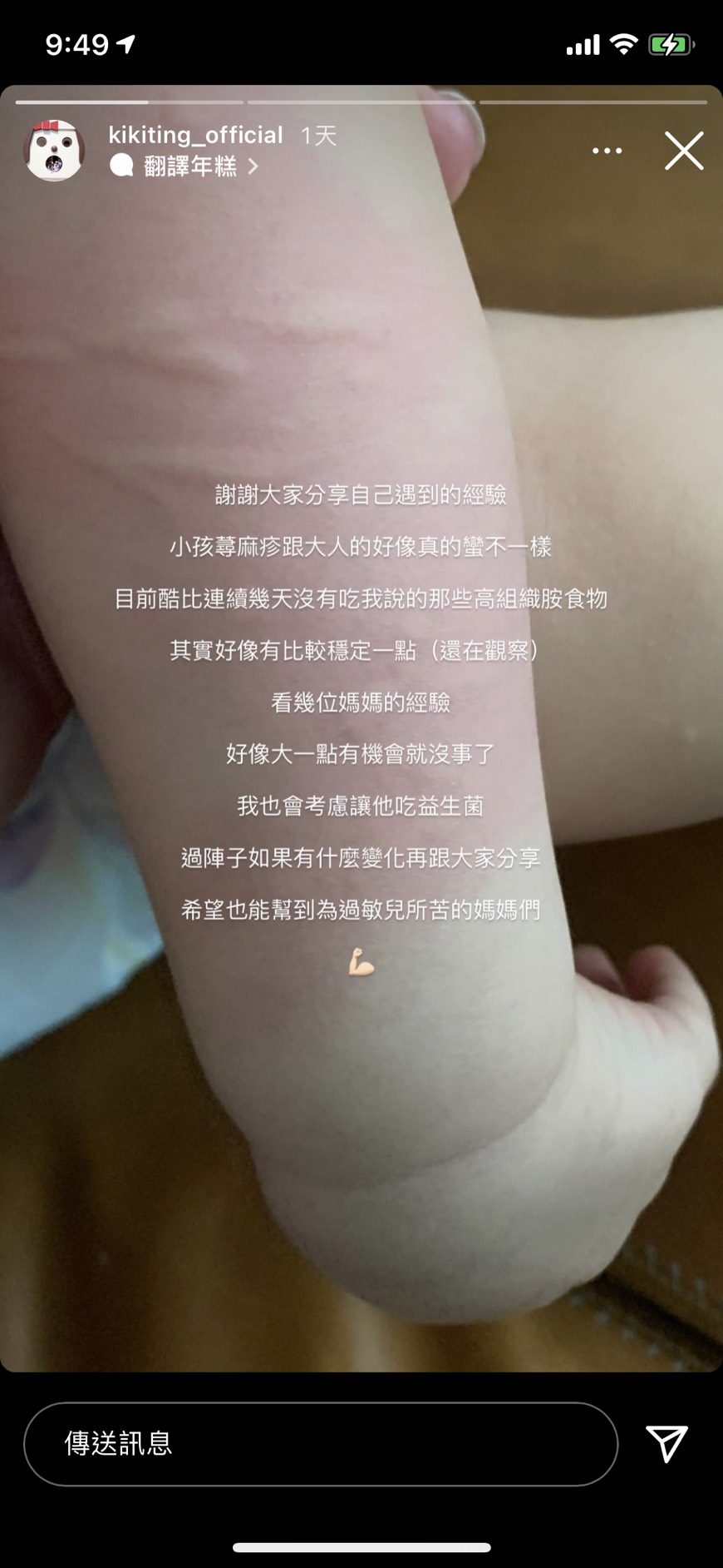 兒子蕁麻疹反覆發作。（圖／翻攝自丁文琪Instagram）