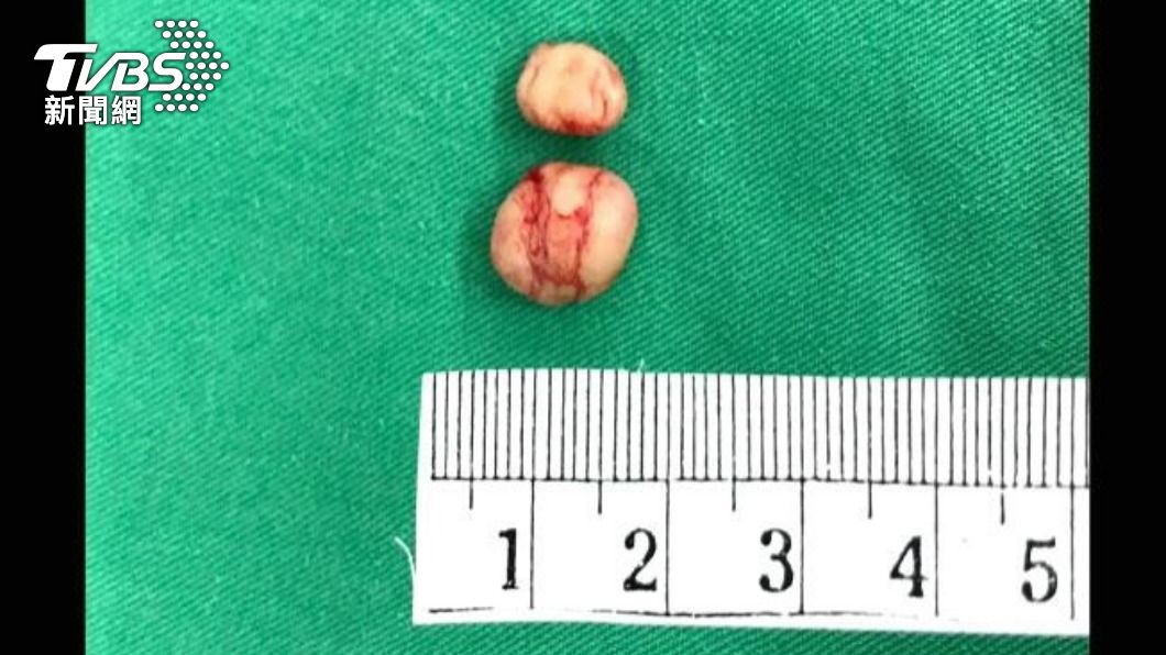 女大生透過手術,切除耳朵上2顆肉瘤。(圖/醫師何俊賢提供)