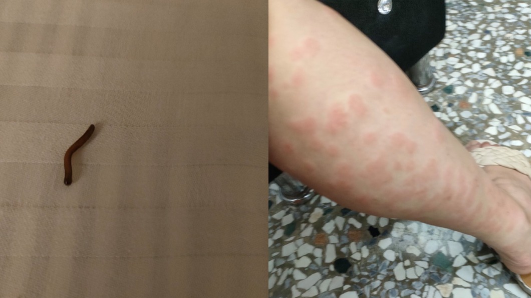 髒舊旅宿床上驚現馬陸！　他被咬醒「滿腿紅疹」