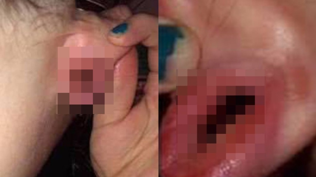 美國女子的耳洞被男友生殖器穿過後發炎。(圖/翻攝自臉書)