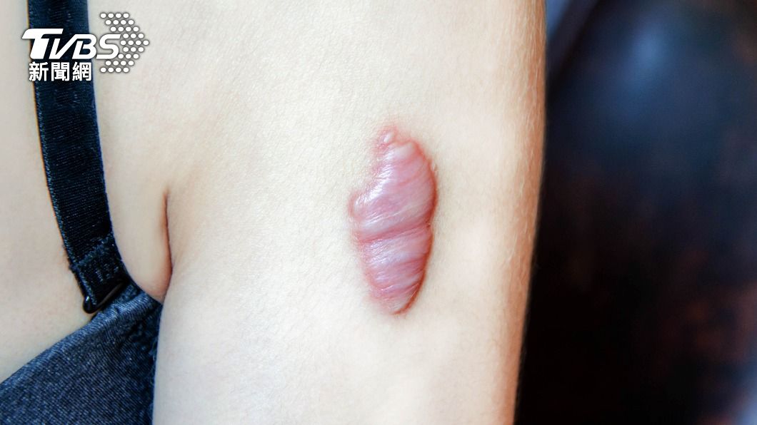 蟹足腫長得像肉瘤。(示意圖/shutterstock達志影像)